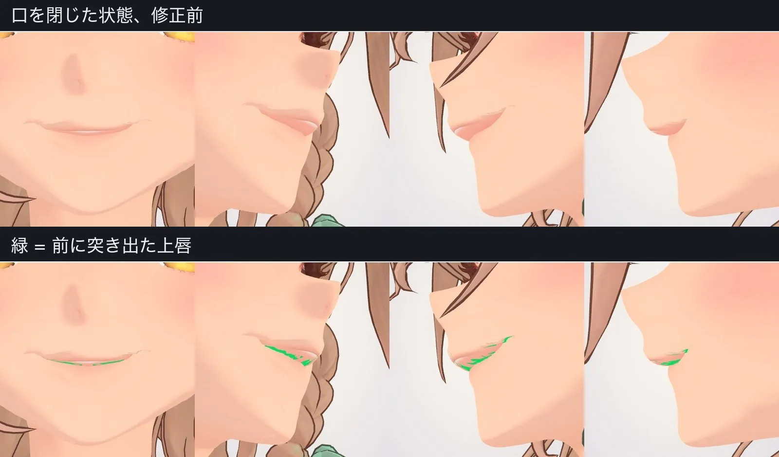 側面からでないと見えない上唇の突き出し